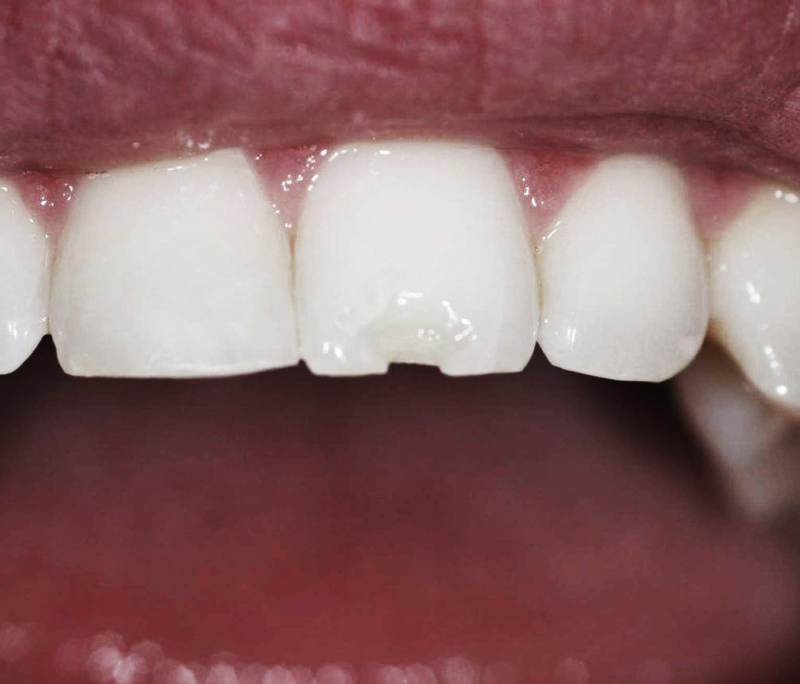 Răng sứ bị mẻ vỡ là do đâu? Cách khắc phục?